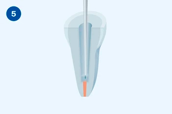 Применение Люксакор Z Дуал Смартмикс - этап 5